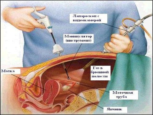 Схема лапороскопической операции апоплексии яичника