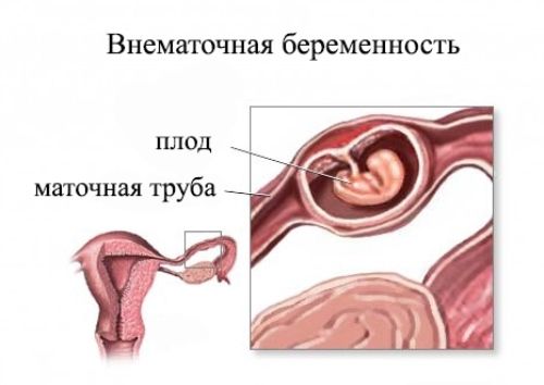 Симптомы внематочной беременности