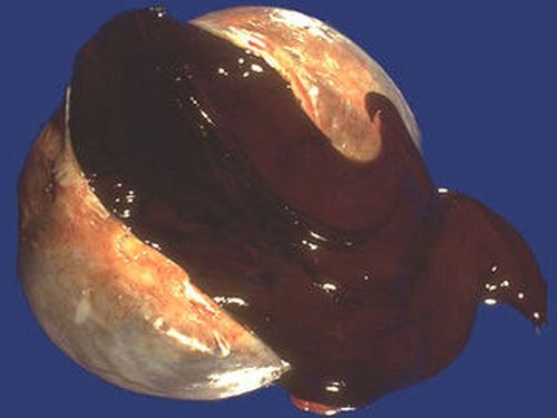 Эндометриоидная киста яичника 