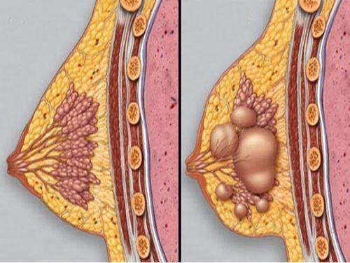 Фиброаденома молочной железы возникает в результате мутагенеза
