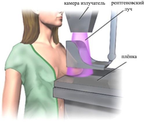 Маммография - метод диагностики молочной железы