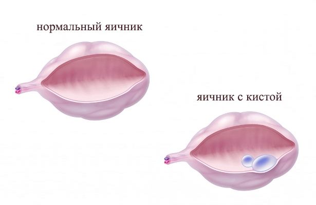 Методы лечения кисты яичника