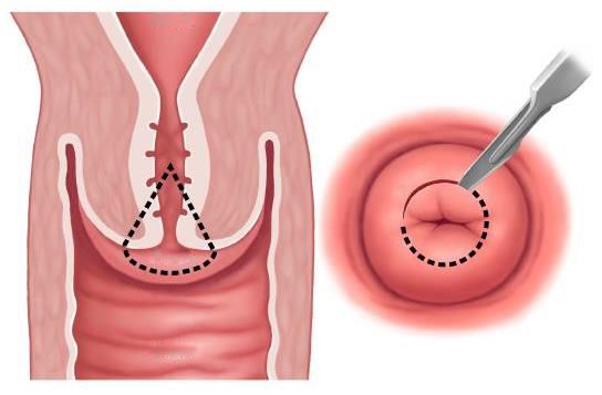 Биопсия шейки матки - метод диагностики патологических изменений