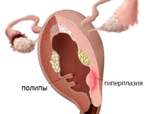 причины гиперплазии эндометрия