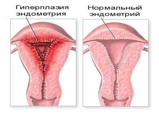 что такое гиперплазия эндометрия и как она выглядит