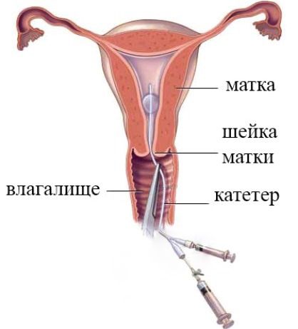 Гсг - метод исследования полости матки и маточных труб