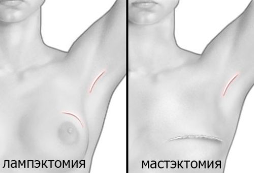 мастэктомия и лампэктомия - методы хирургического лечения рака молочной железы