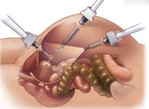 Удаление миомы матки лапароскопическим методом - щадящий метод удаления миоматозного узла