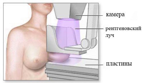 Метод диагностики молочной железы - рентгеновская маммография