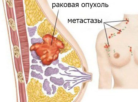 метастазы при раке молочной железы