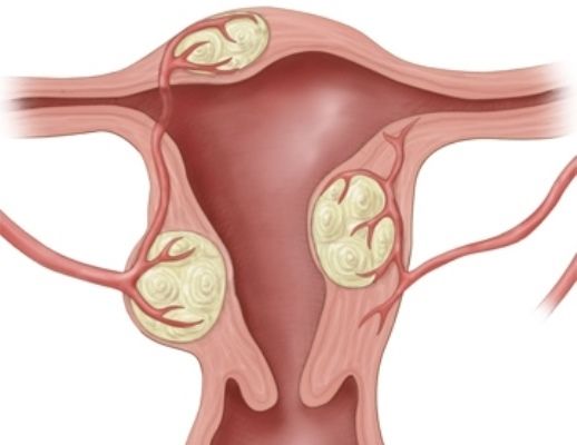 Миома матки - основные симптомы и методы лечения патологии
