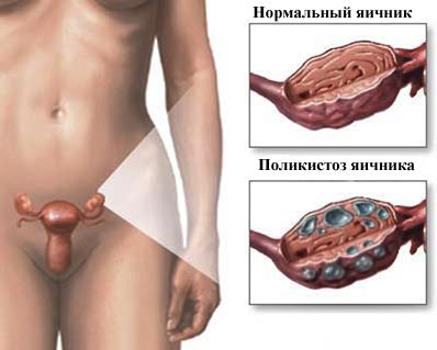 Поликистоз яичников или синдром Штейна-Левинталя