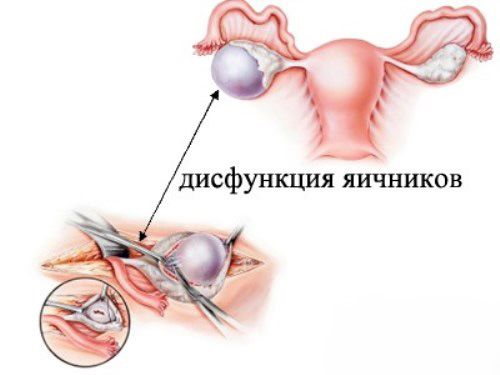 Основные признаки и симптомы дисфункции яичников
