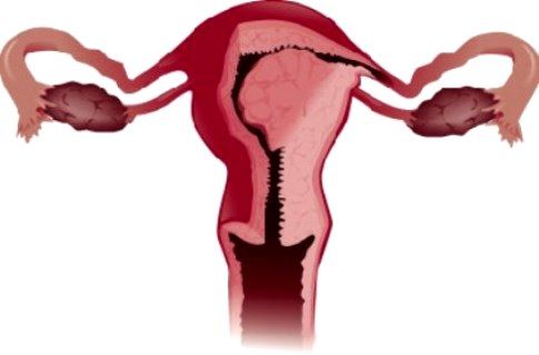 Что такое рак тела матки