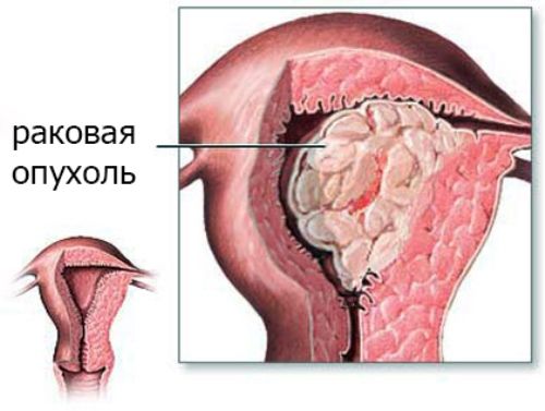 Раковая опухоль в теле матки