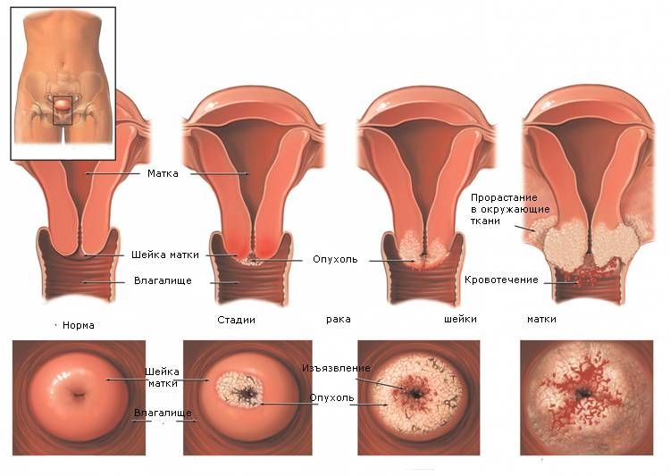Как развивается рак шейки матки