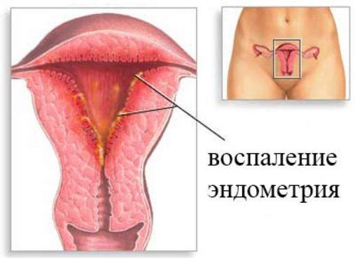 Основные признаки эндометрита матки 
